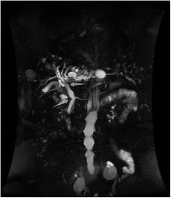 Endoscopic Endoluminal Radiofrequency Ablation and Single-Operator Peroral Cholangioscopy System (SpyGlass) in the Diagnosis and Treatment of Intraductal Papillary Neoplasm of the Bile Duct: A Case Report and Literature Review